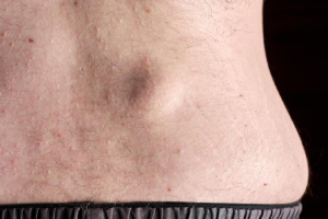 Lipoma Removal Service